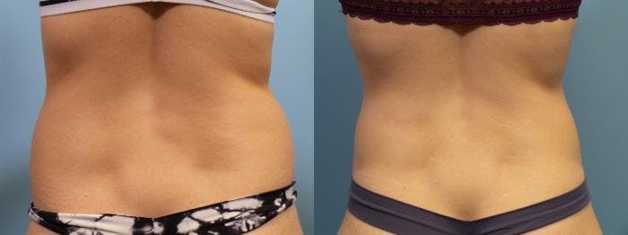Liposuction Before & After Gallery - Patient 103472 - Image 4