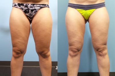 Liposuction Before & After Gallery - Patient 103472 - Image 5