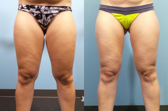 Liposuction Before & After Gallery - Patient 103472 - Image 5