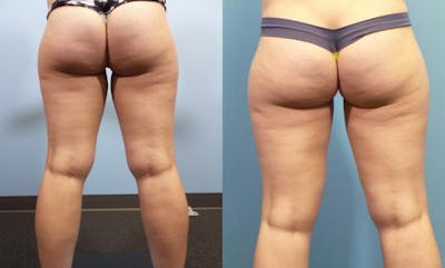 Liposuction Before & After Gallery - Patient 103472 - Image 6