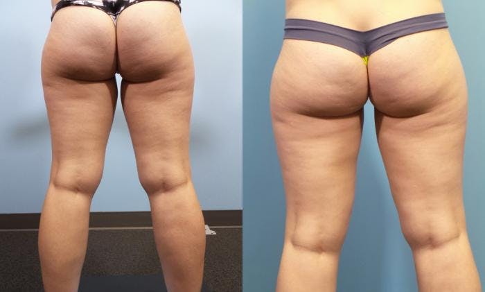 Liposuction Before & After Gallery - Patient 103472 - Image 6