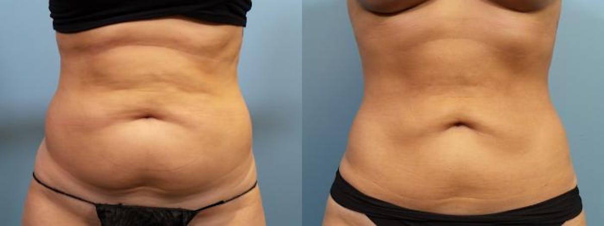 Liposuction Before & After Gallery - Patient 404158 - Image 1