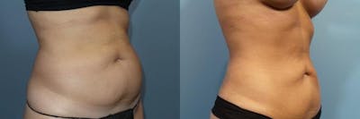 Liposuction Before & After Gallery - Patient 404158 - Image 2