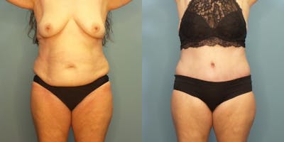 Liposuction Before & After Gallery - Patient 393402 - Image 1