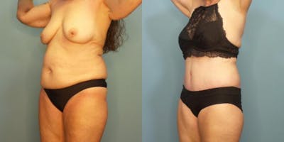 Liposuction Before & After Gallery - Patient 393402 - Image 2