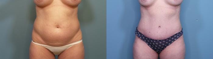 Liposuction Before & After Gallery - Patient 932080 - Image 1
