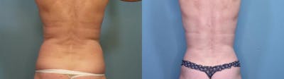 Liposuction Before & After Gallery - Patient 932080 - Image 2