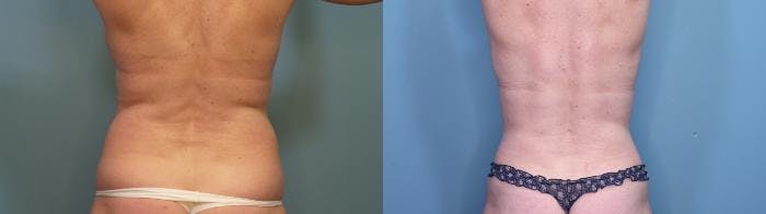 Liposuction Before & After Gallery - Patient 932080 - Image 2