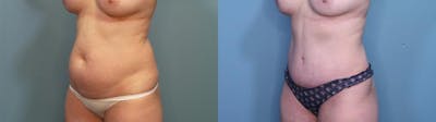Liposuction Before & After Gallery - Patient 932080 - Image 3