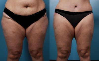 Liposuction Before & After Gallery - Patient 333149 - Image 1