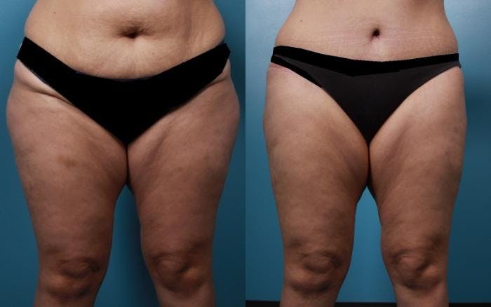 Liposuction Before & After Gallery - Patient 333149 - Image 1