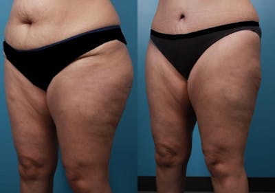 Liposuction Before & After Gallery - Patient 333149 - Image 2