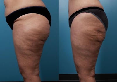 Liposuction Before & After Gallery - Patient 333149 - Image 3