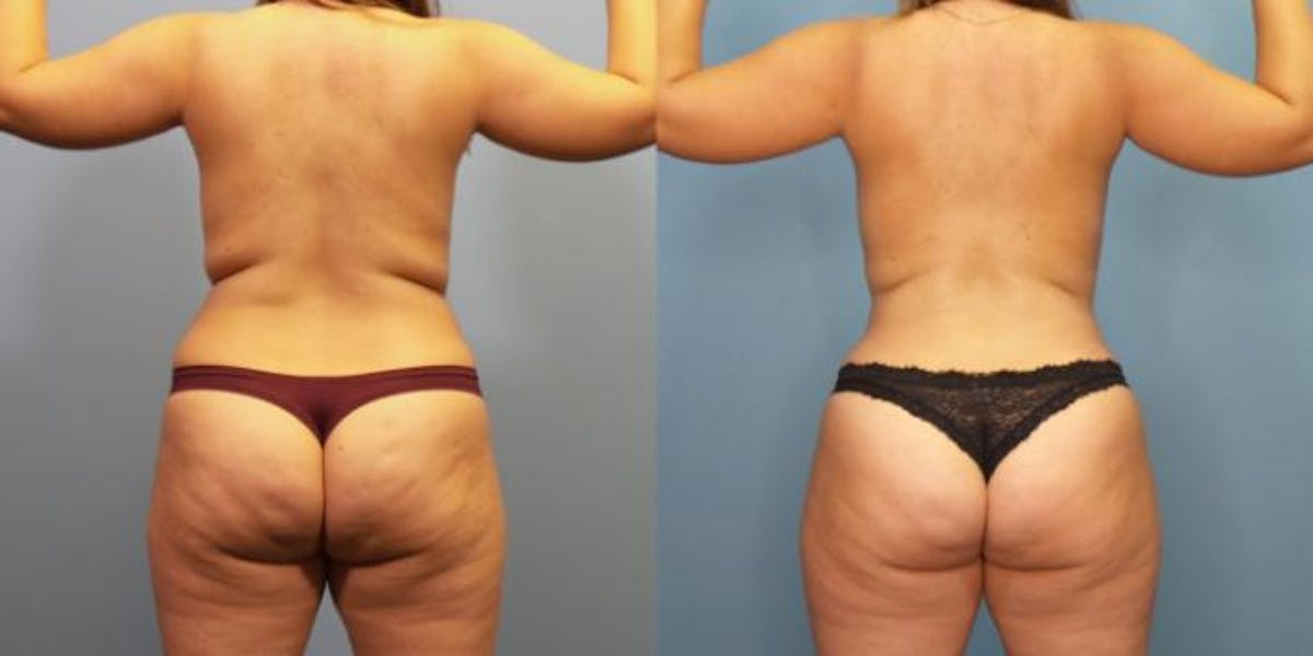 Liposuction Before & After Gallery - Patient 288540 - Image 1