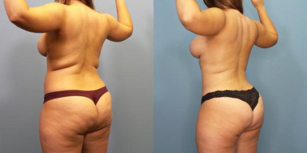 Liposuction Before & After Gallery - Patient 288540 - Image 2