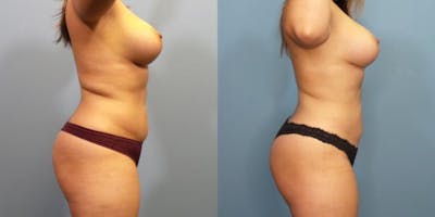 Liposuction Before & After Gallery - Patient 288540 - Image 3