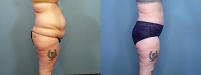Liposuction Before & After Gallery - Patient 333718 - Image 3