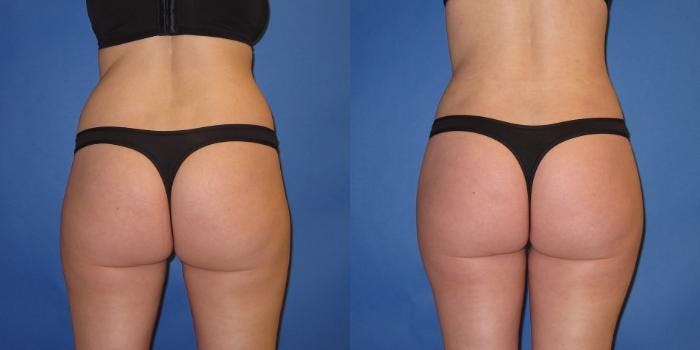 Liposuction Before & After Gallery - Patient 195558 - Image 1