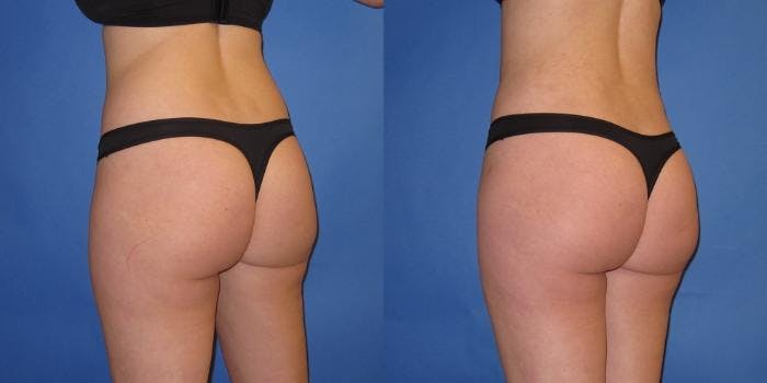 Liposuction Before & After Gallery - Patient 195558 - Image 2