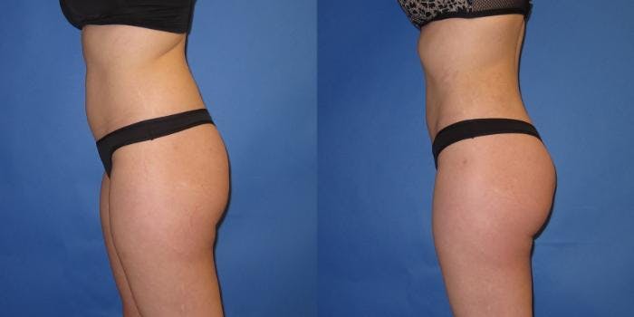 Liposuction Before & After Gallery - Patient 195558 - Image 3