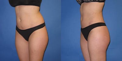 Liposuction Before & After Gallery - Patient 195558 - Image 4