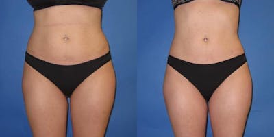 Liposuction Before & After Gallery - Patient 195558 - Image 5
