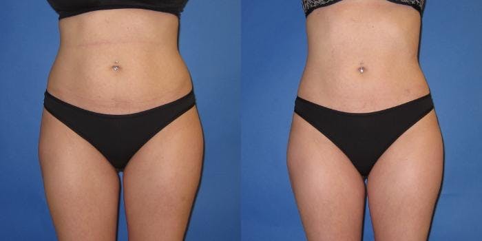 Liposuction Before & After Gallery - Patient 195558 - Image 5