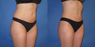 Liposuction Before & After Gallery - Patient 195558 - Image 6