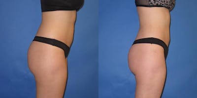 Liposuction Before & After Gallery - Patient 195558 - Image 7