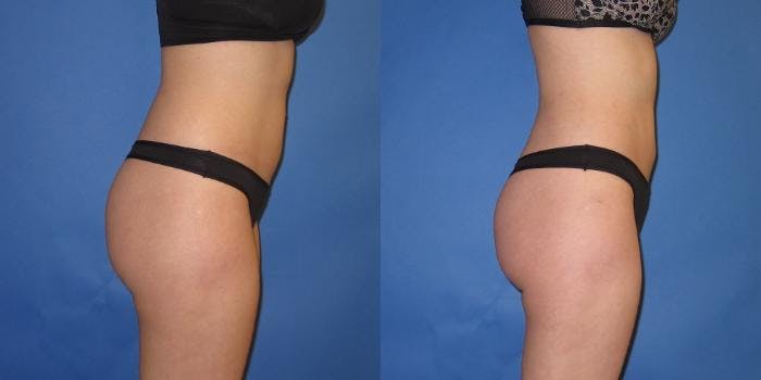 Liposuction Before & After Gallery - Patient 195558 - Image 7