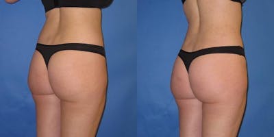 Liposuction Before & After Gallery - Patient 195558 - Image 8