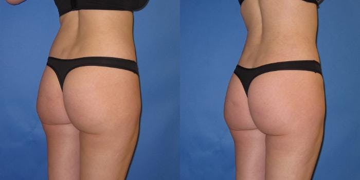 Liposuction Before & After Gallery - Patient 195558 - Image 8