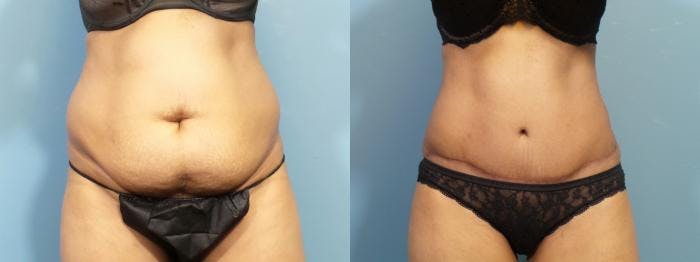 Liposuction Before & After Gallery - Patient 178187 - Image 1