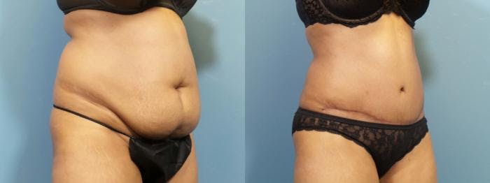 Liposuction Before & After Gallery - Patient 178187 - Image 2