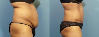 Liposuction Before & After Gallery - Patient 178187 - Image 3