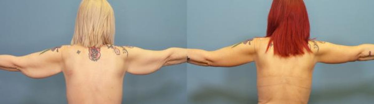Massive Weight Loss/Body Lift Before & After Gallery - Patient 303636 - Image 1