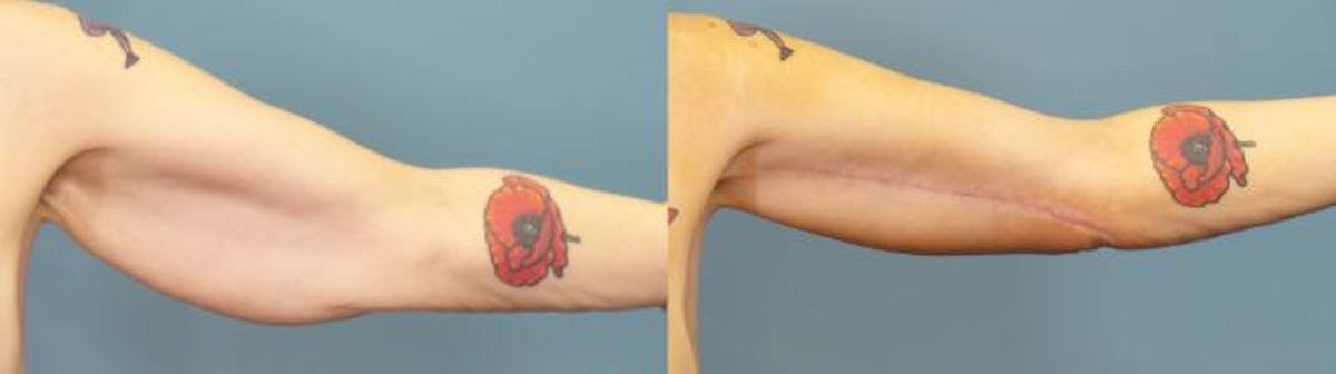 Massive Weight Loss/Body Lift Before & After Gallery - Patient 303636 - Image 2