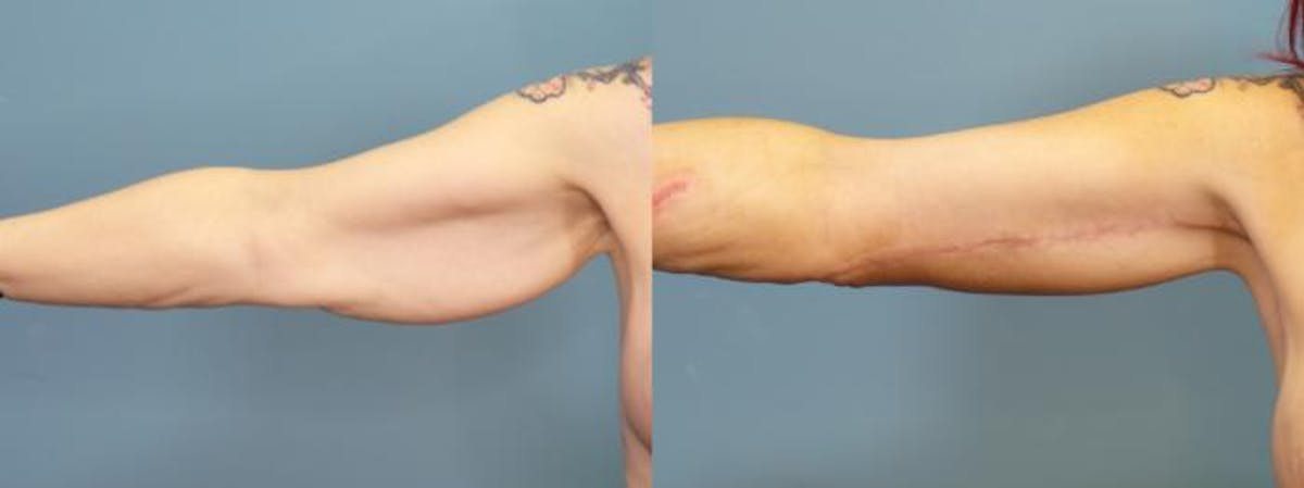 Massive Weight Loss/Body Lift Before & After Gallery - Patient 303636 - Image 3