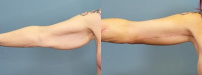 Massive Weight Loss/Body Lift Before & After Gallery - Patient 303636 - Image 3