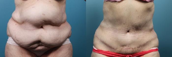 Massive Weight Loss/Body Lift Before & After Gallery - Patient 246047 - Image 1