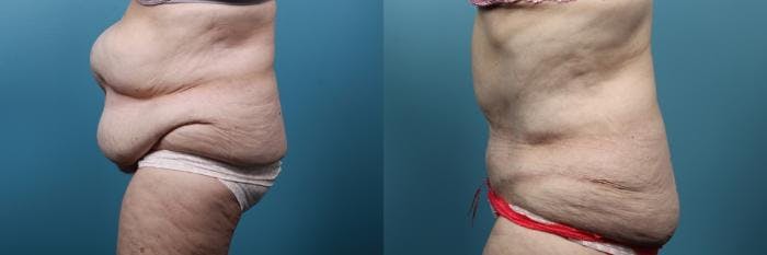 Massive Weight Loss/Body Lift Before & After Gallery - Patient 246047 - Image 2