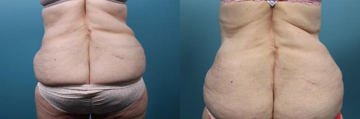 Massive Weight Loss/Body Lift Before & After Gallery - Patient 246047 - Image 3