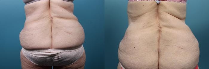 Massive Weight Loss/Body Lift Before & After Gallery - Patient 246047 - Image 3