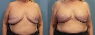 Massive Weight Loss/Body Lift Before & After Gallery - Patient 214867 - Image 1