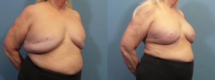 Massive Weight Loss/Body Lift Before & After Gallery - Patient 214867 - Image 2