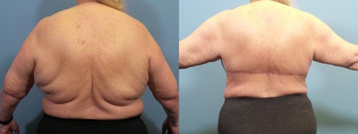 Massive Weight Loss/Body Lift Before & After Gallery - Patient 214867 - Image 3