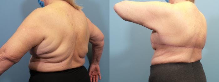 Massive Weight Loss/Body Lift Before & After Gallery - Patient 214867 - Image 4