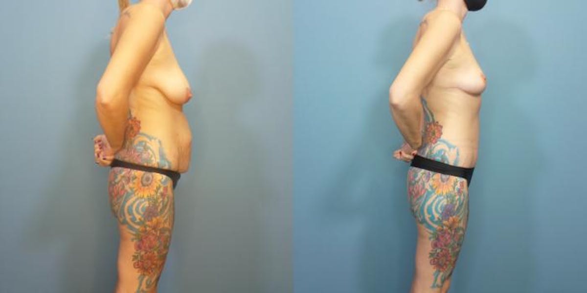 Massive Weight Loss/Body Lift Before & After Gallery - Patient 270315 - Image 1