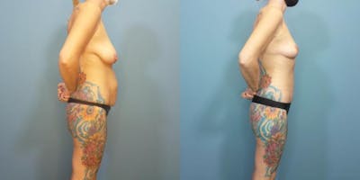 Massive Weight Loss/Body Lift Before & After Gallery - Patient 270315 - Image 1