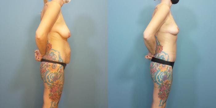 Massive Weight Loss/Body Lift Before & After Gallery - Patient 270315 - Image 1